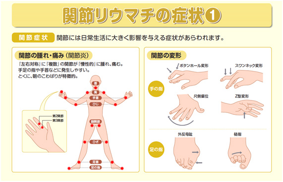 関節 リウマチ で 起こり にくい の は どれ か