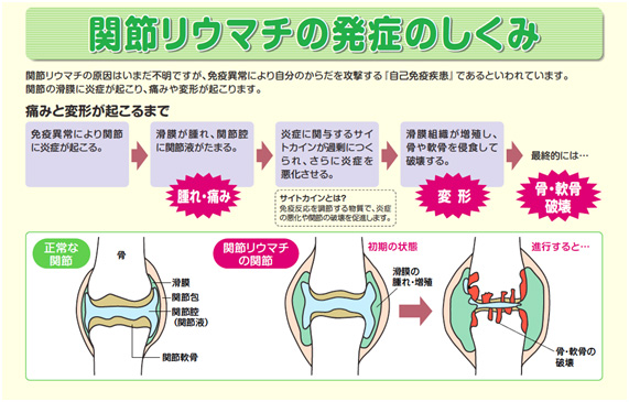 関節リウマチ発症のしくみ