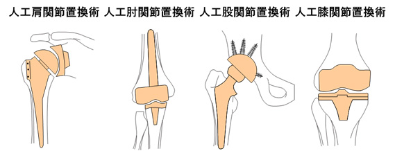 人工関節置換術