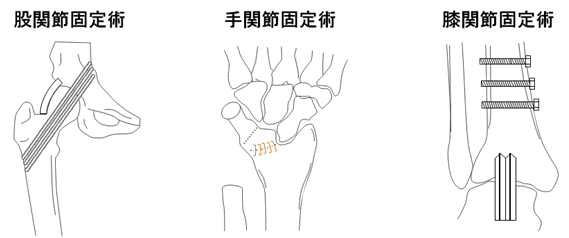 関節固定術